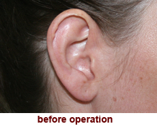 plastic-surgery-prominent-ear 